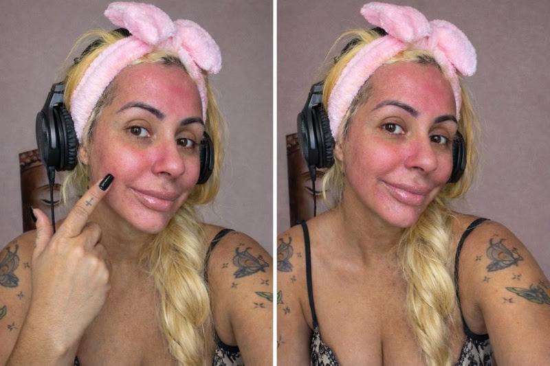 Ex-Miss Bumbum exibe reação alérgica após usar skincare com o próprio sangue menstrual